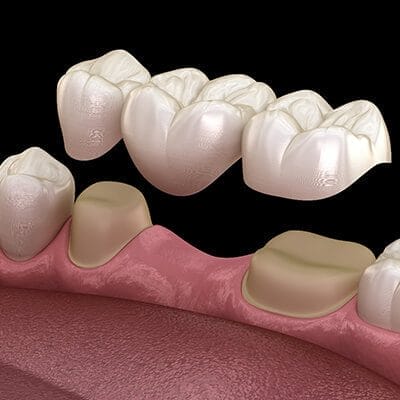 Infographic of human in dental bridge on white background illustration. Ivy Lane Dentistry offers Dental Bridges in San Antonio, TX. <a href="https://www.freepik.com/free-vector/infographic-human-dental-bridge-white-background_24779460.htm#query=dental%20bridge&position=0&from_view=keyword&track=ais">Image by brgfx</a> on Freepik